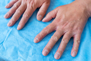Psoriasis on the hands of a man. Dry male hand on a blue background. Hike to the doctor, treatment...