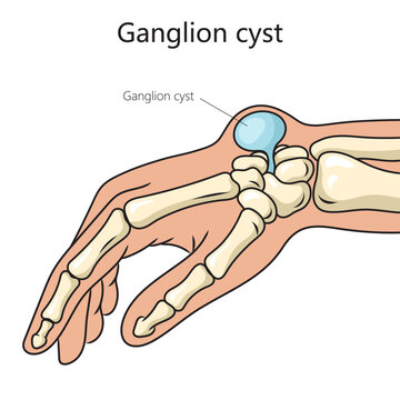 Ganglion cyst structure disease diagram schematic vector illustration. Medical science educational illustration