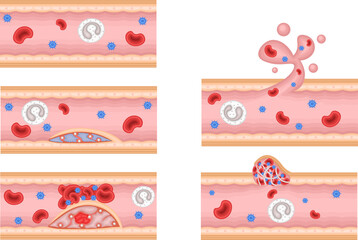 血管　動脈硬化　血管修復　イラスト