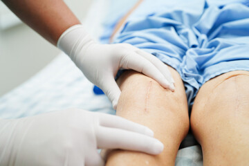 Doctor checking Asian elderly woman patient with scar knee replacement surgery in hospital.