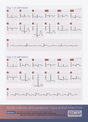 Male, 84 years old, admitted to hospital with chest pain for 1 day. ECG showed acute inferior and posterior MI and possibly right MI. The patient died of ventricular fibrillation the next day.