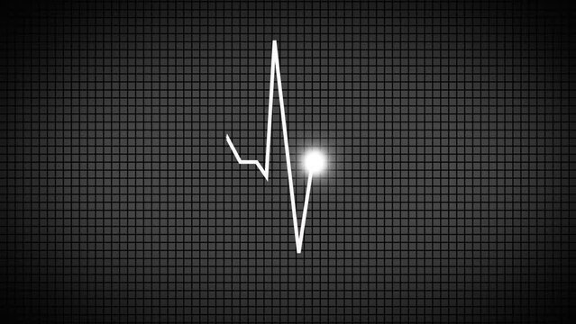 ECG with supraventricular premature beats and short paroxysms of neon atrial fibrillation animation