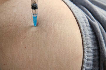 Needle injecting into the muscle. Nurse doing a trigger point injection in patient back. Close up...