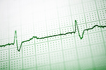 Close-up of an electrocardiogram printed on green paper.