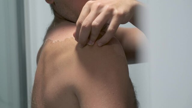 Man touching and peeling of sun damaged peeling skin with a hand on a back. Sunburn skin. The skin peels off, burnt skin