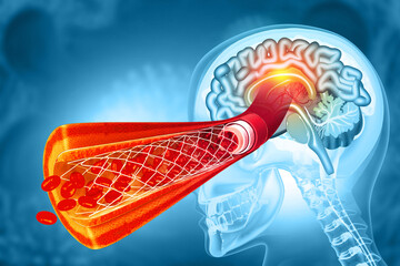 Balloon angioplasty procedure with stent in vein. 3d illustration