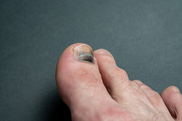 finger with nail damage and bruise