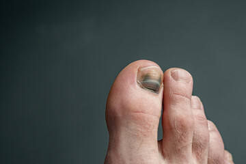 finger with nail damage and bruise