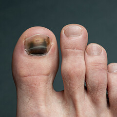 toe with nail damage and bruise
