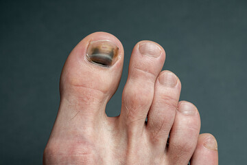 finger with nail damage and bruise