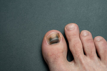 finger with nail damage and bruise