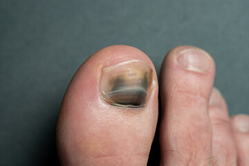 finger with nail damage and bruise