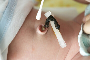 Treatment of the navel and umbilical cord of a newborn with hydrogen peroxide and a cotton swab to dry and heal the umbilical cord of an infant. Medical - obrazy, fototapety, plakaty