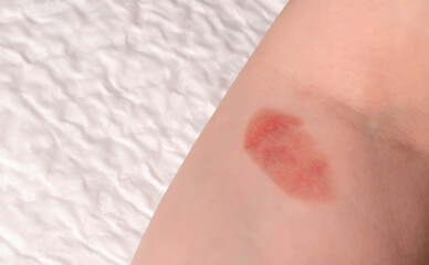 Red spot on the skin, skin damage from a burn on the arm. Copy space for text