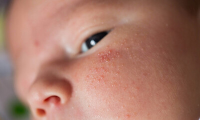 Rash on the face of a newborn baby. The process of formation of the hormonal system, close-up