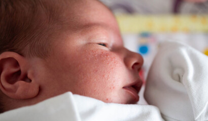 Allergic pimples in a newborn on the face. Pathogenesis, acne of newborns.
