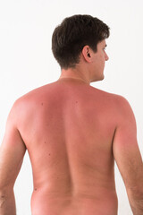 Fototapeta premium back of a man in his thirties with sunburn, with redness of the skin