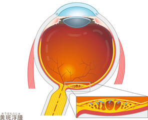 眼球・黄斑浮腫・macular edema・イラスト・eye・illustration
