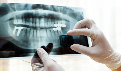Dentist examining a panoramic dental x-ray - obrazy, fototapety, plakaty