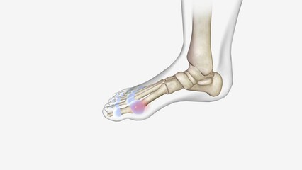 Gout flares usually occur in one joint and can be triggered by certain foods, alcohol, certain medications, physical trauma, or certain