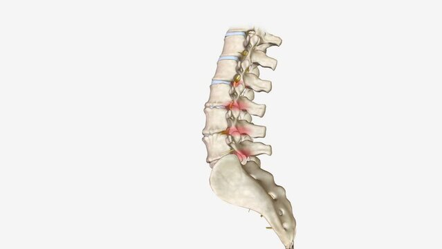 Degenerative disc disease isn't actually a disease, but rather a condition in which a damaged disc causes pain