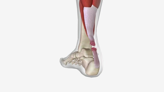 Flexion and Extension with Torn Achilles Tendon