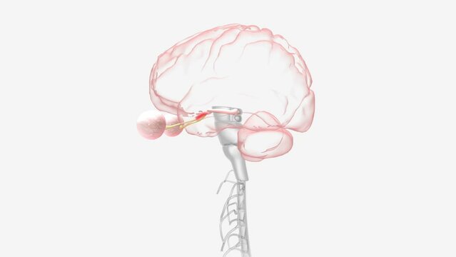 Optic neuritis occurs when swelling (inflammation) damages the optic nerve