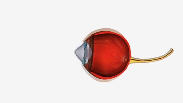 Keratoconus is a vision disorder that occurs when the normally round cornea becomes thin and irregular (cone) shaped.