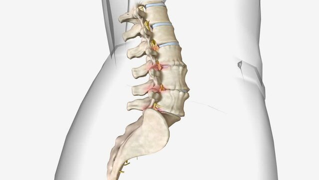 Degenerative disc disease isn't actually a disease, but rather a condition in which a damaged disc causes pain