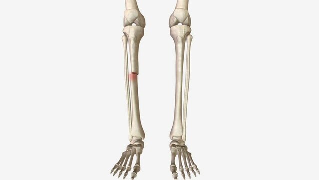 open fracture, also called a compound fracture, is a fracture in which there is an open wound or break in the skin near the site of the broken bone