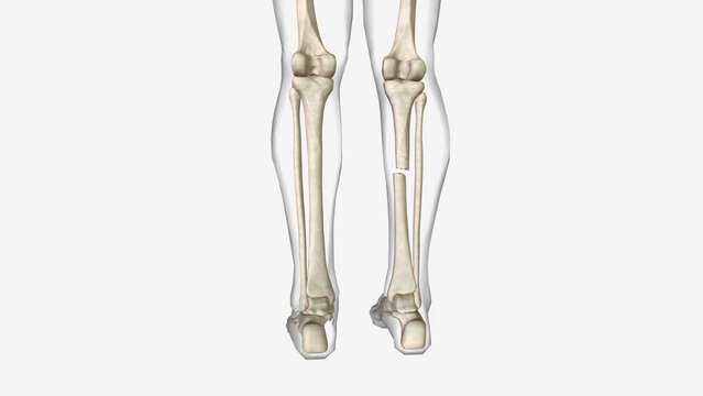 open fracture, also called a compound fracture, is a fracture in which there is an open wound or break in the skin near the site of the broken bone