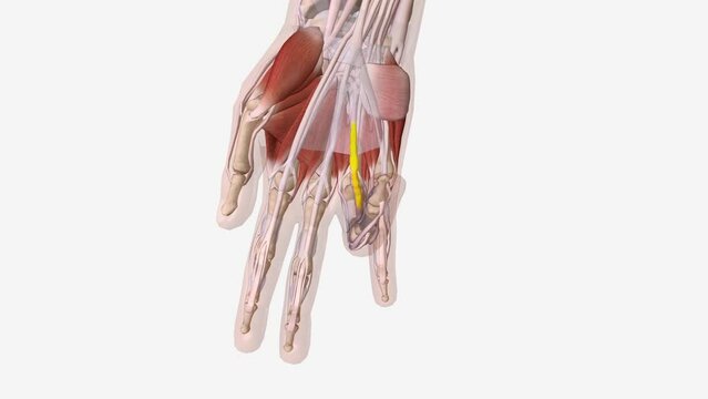 Dupuytren is Contracture Central Cord