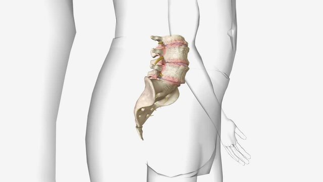Degenerative spondylolisthesis (DS) is a disorder that causes the slip of one vertebral body over the one below due to degenerative changes in the spine