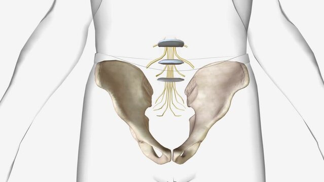 Degenerative spondylolisthesis (DS) is a disorder that causes the slip of one vertebral body over the one below due to degenerative changes in the spine