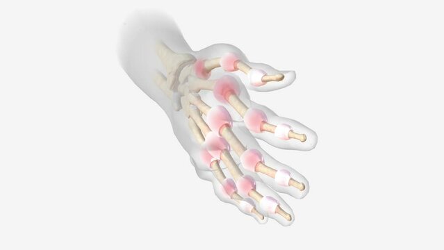 Advanced Rheumatoid Arthritis