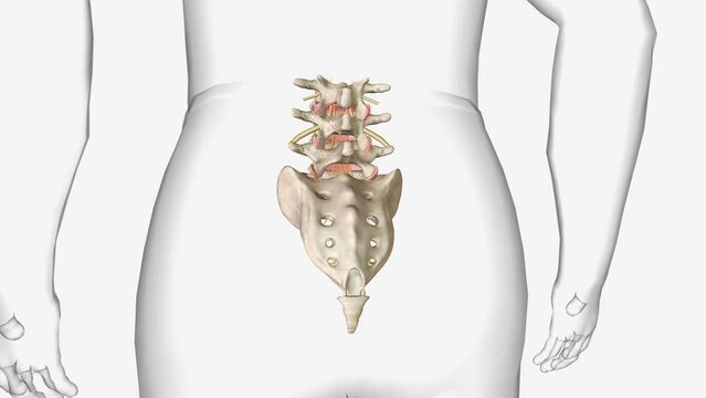 Degenerative spondylolisthesis (DS) is a disorder that causes the slip of one vertebral body over the one below due to degenerative changes in the spine