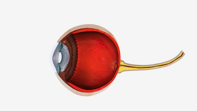 Ocular hypertension refers to high intraocular pressure