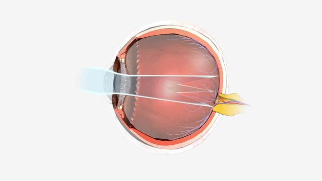 Astigmatism is a type of refractive error. Astigmatism occurs when the cornea or lens is curved more steeply in one direction than in another