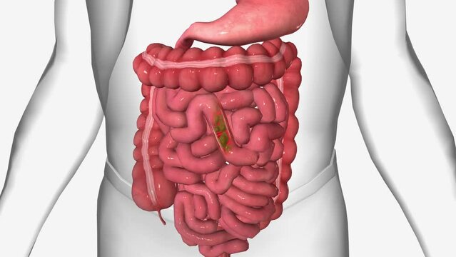 Diarrhea is when your stools are loose and watery. You may also need to go to the bathroom more often