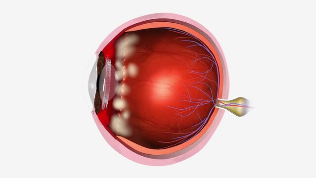 The pars plana is a narrow section of the ciliary body, inflammation of which is known as pars planitis