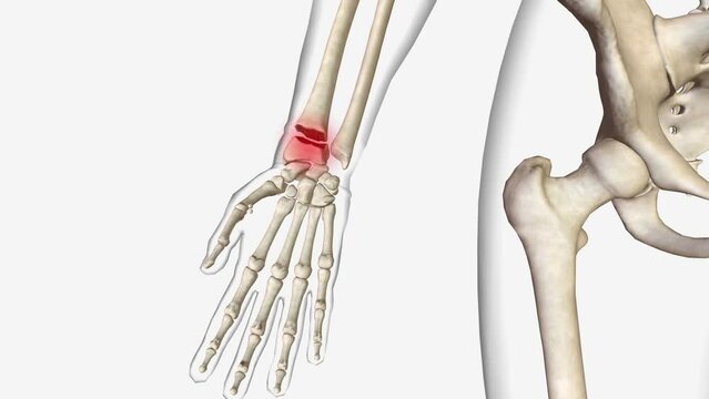 Distal radius fractures are the most common orthopaedic injury and generally result from fall on an outstretched hand
