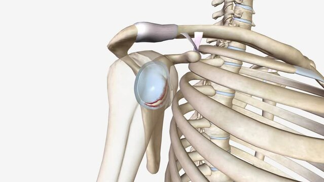 A Bankart lesion occurs as the result of a forward shoulder dislocation