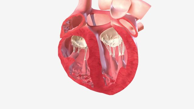 Atrial Septal Defect Blood Flow Enlarged right ventricie