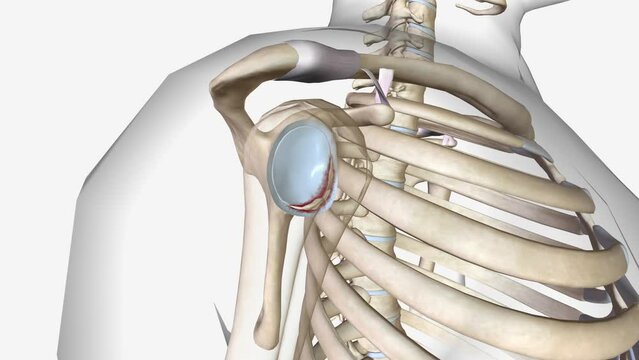 A Bankart lesion occurs as the result of a forward shoulder dislocation