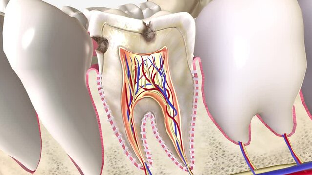 Cavities are permanently damaged areas in the hard surface of your teeth that develop into tiny openings or holes
