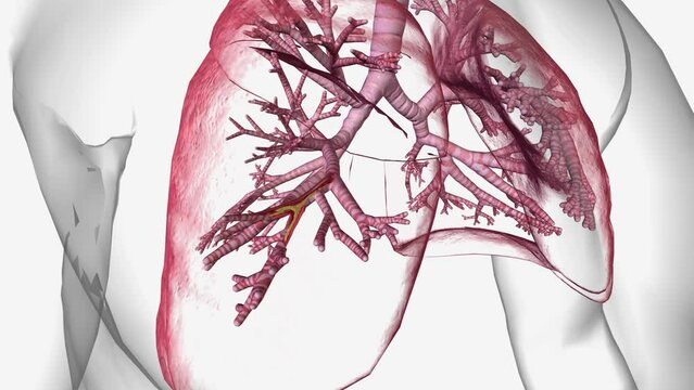 Bronchiectasis is a long-term condition where the airways of the lungs become widened