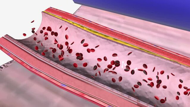 Atherosclerosis is a specific type of arteriosclerosis