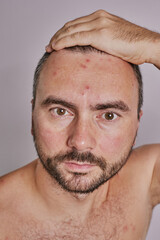 Man's forehead with acne, red spots, skin disease