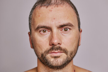 Obraz premium Man's forehead with acne, red spots, skin disease