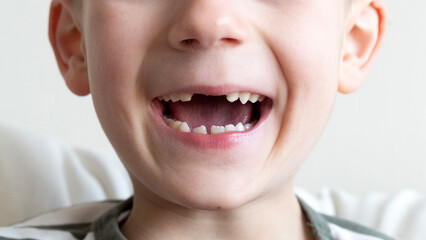 toothless smile child close-up. boy without milk front teeth